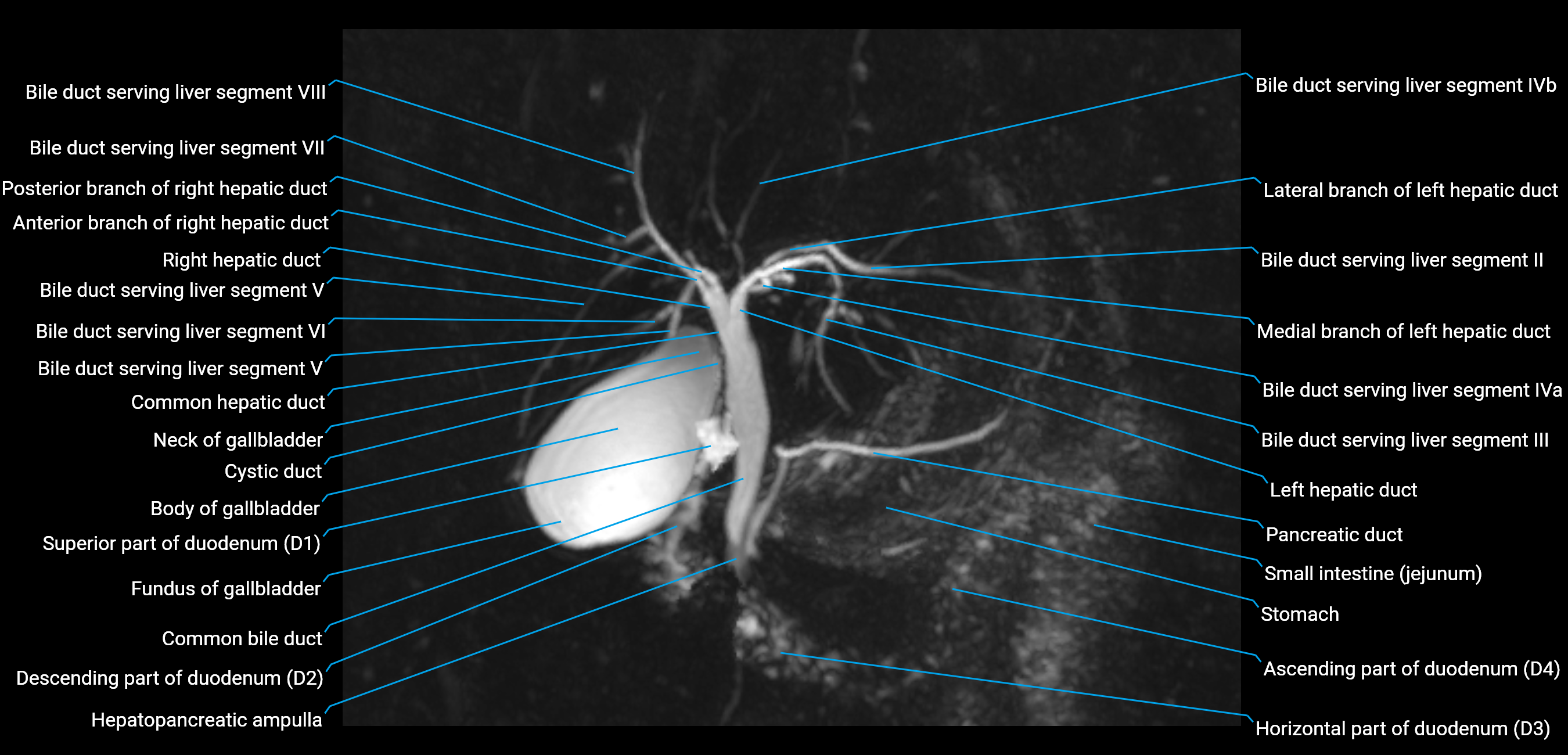 MRCP MIP MRI  anatomy labelled image-img-01003-00013.png